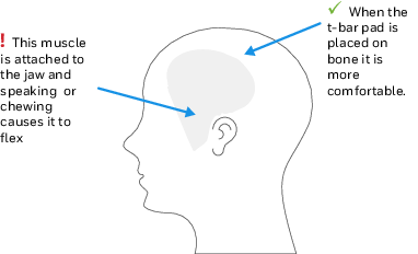 T-bar Pad Placement on the Head