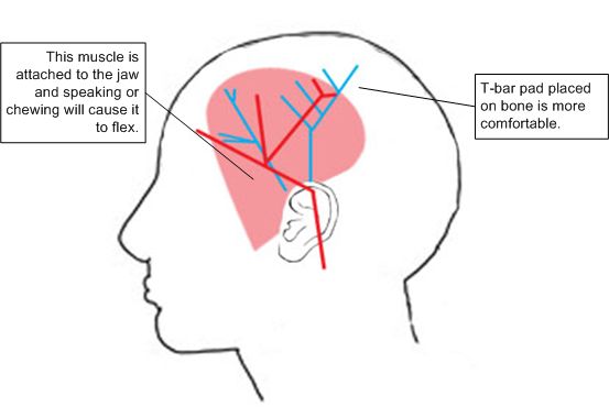 T-bar Pad Placement on the Head